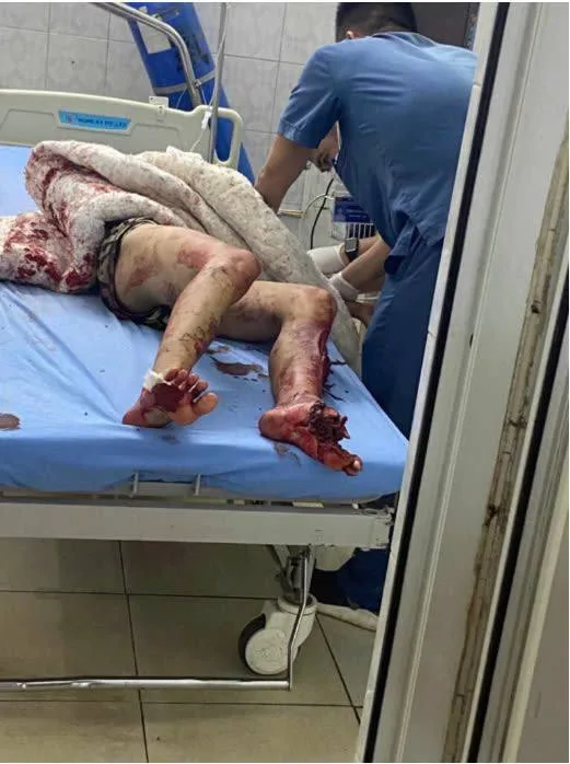 Quan Hóa – Thanh Hóa đêm qua, 1 vụ TNGT nghiêm trọng, nạn nhân rơi 1 phần chân ra đường